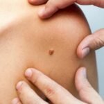 вірус папіломи людини